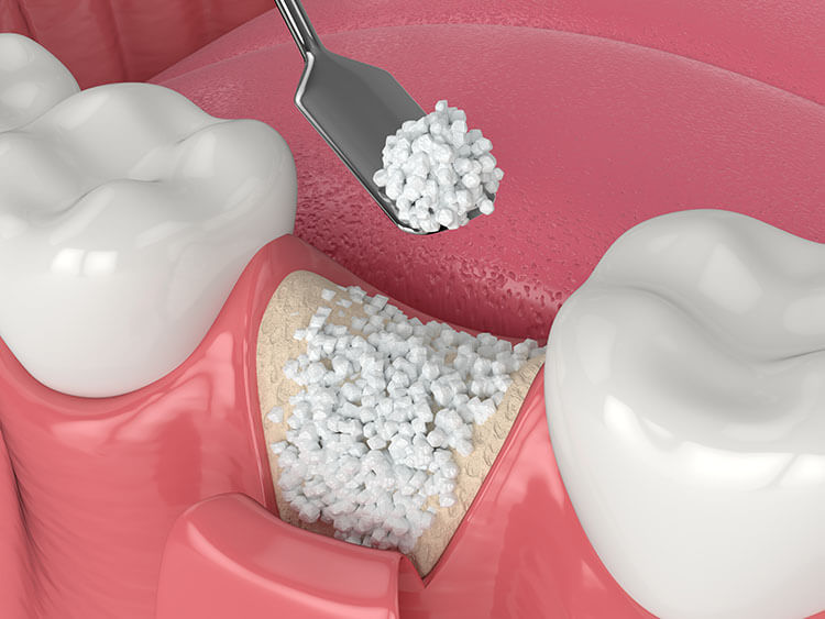 Bone grafting procedure