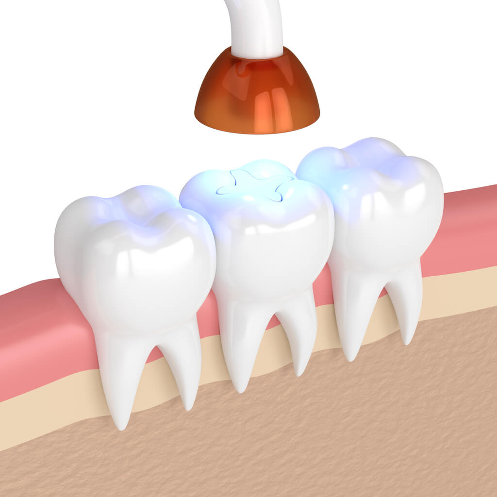 cavity fillings