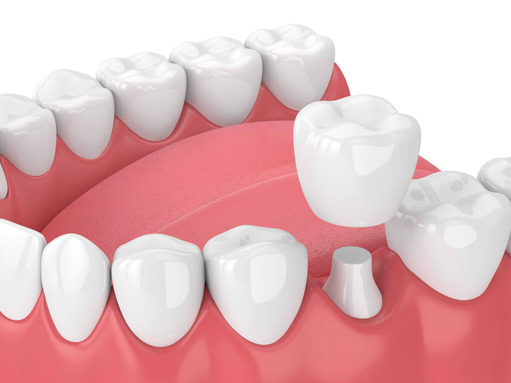 Dental crown 3D visual