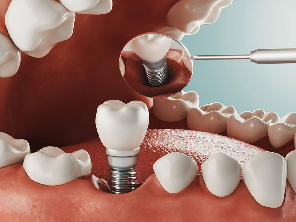 dental implant 3D visual