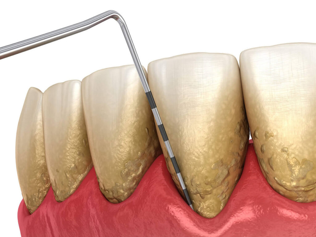 3D visual of a gum disease