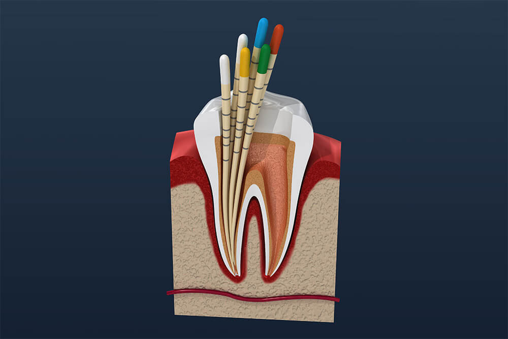 Root canal treatment 3D visual