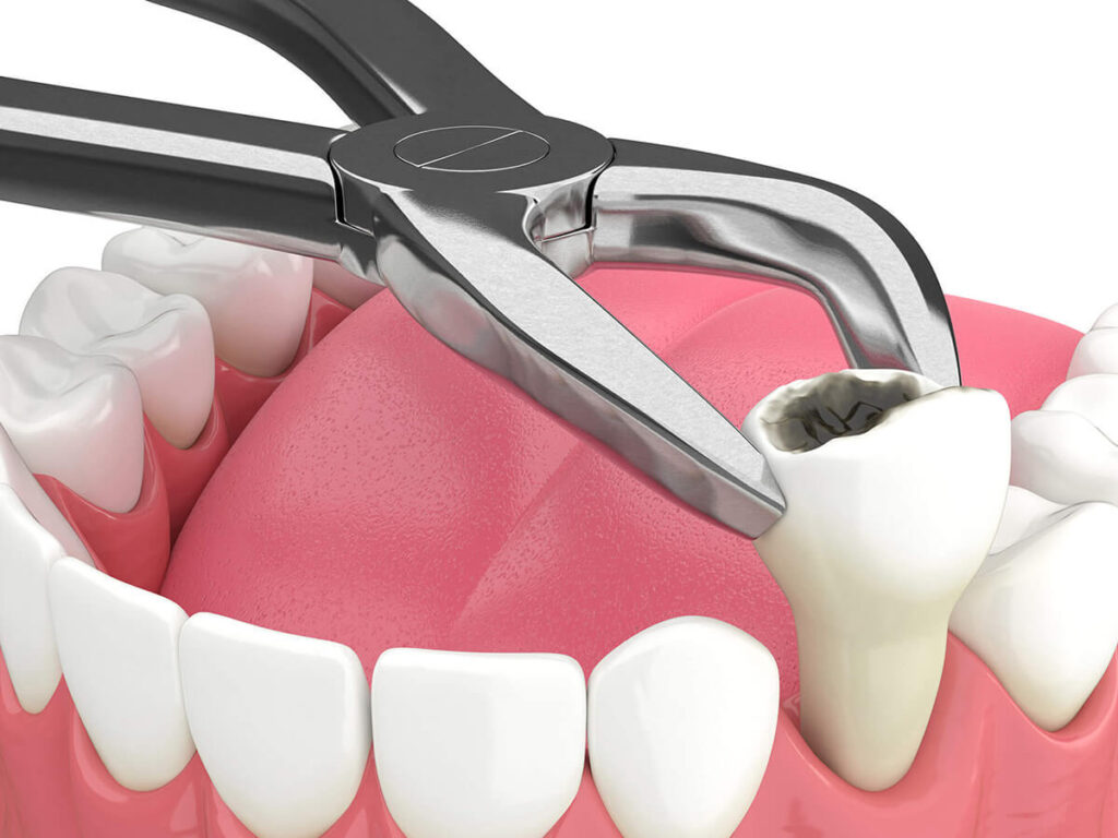 tooth extraction 3D visual